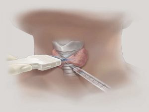 Tiroid Biyopsisi Nasıl Yapılır